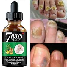 Sérum Antihongos King of Ginger - Devuelve la Salud a tus Pies